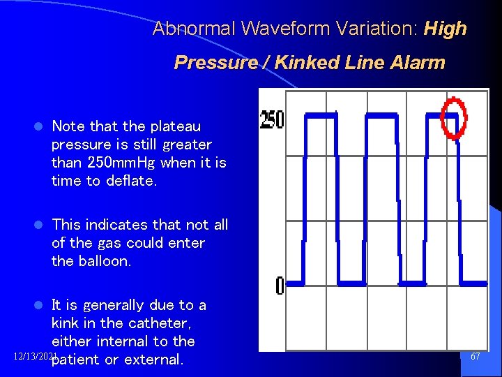 Abnormal Waveform Variation: High Pressure / Kinked Line Alarm l Note that the plateau