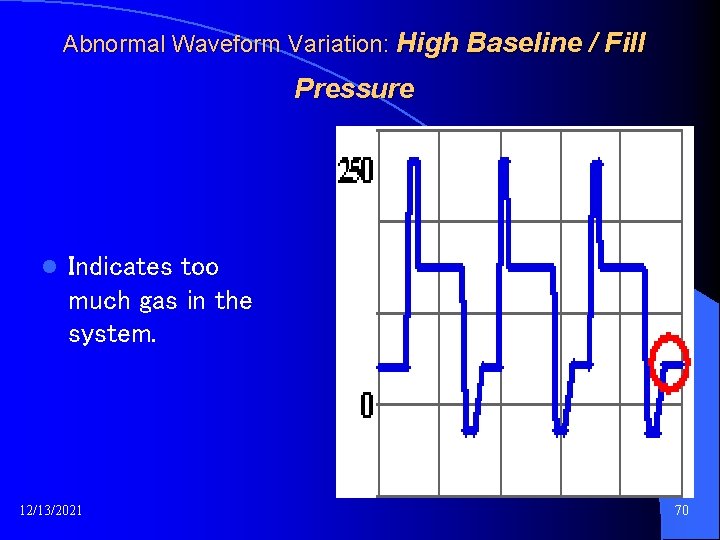 Abnormal Waveform Variation: High Baseline / Fill Pressure l Indicates too much gas in