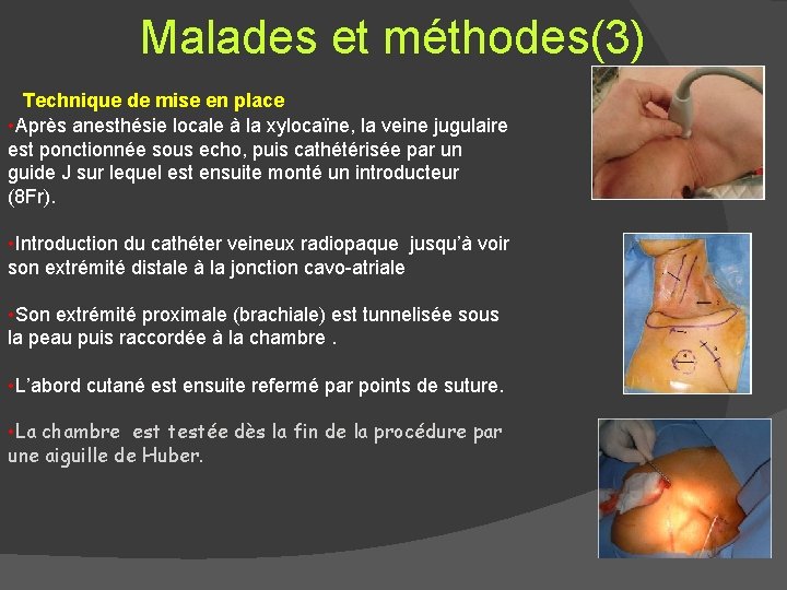 Malades et méthodes(3) Technique de mise en place • Après anesthésie locale à la