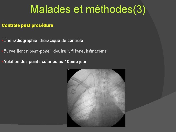 Malades et méthodes(3) Contrôle post procédure • Une radiographie thoracique de contrôle • Surveillance