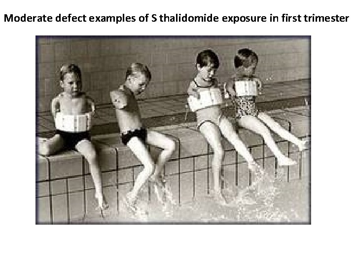 Moderate defect examples of S thalidomide exposure in first trimester 