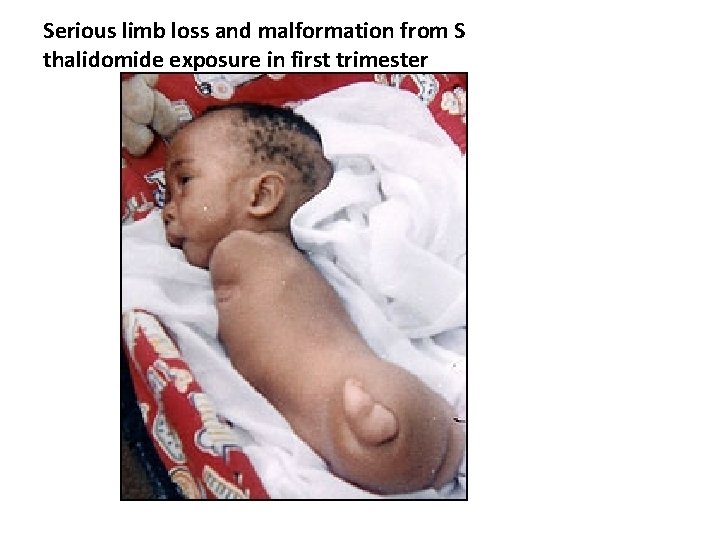 Serious limb loss and malformation from S thalidomide exposure in first trimester 