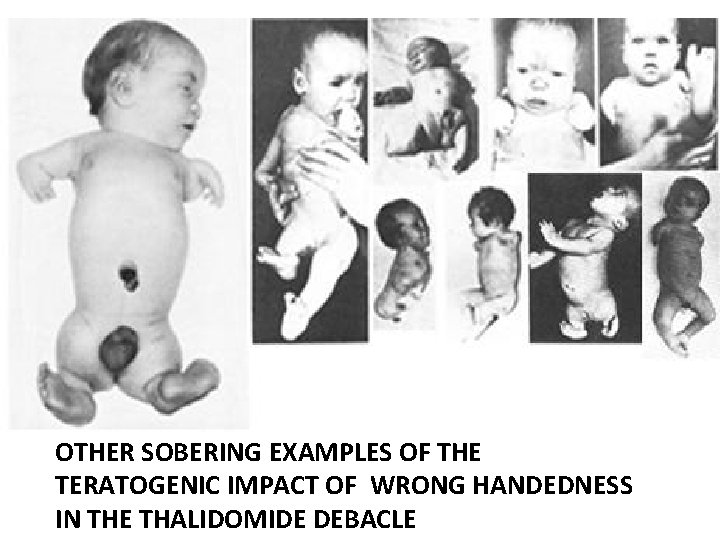 OTHER SOBERING EXAMPLES OF THE TERATOGENIC IMPACT OF WRONG HANDEDNESS IN THE THALIDOMIDE DEBACLE