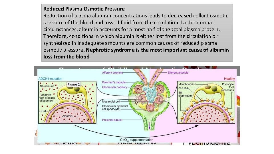 Reduced Plasma Osmotic Pressure Reduction of plasma albumin concentrations leads to decreased colloid osmotic