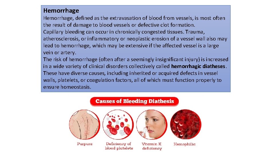 Hemorrhage, defined as the extravasation of blood from vessels, is most often the result