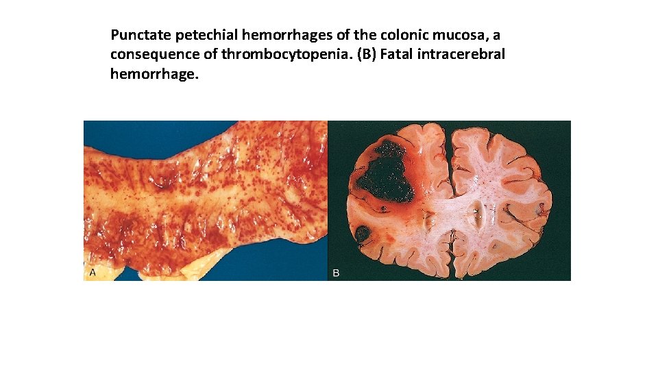 Punctate petechial hemorrhages of the colonic mucosa, a consequence of thrombocytopenia. (B) Fatal intracerebral