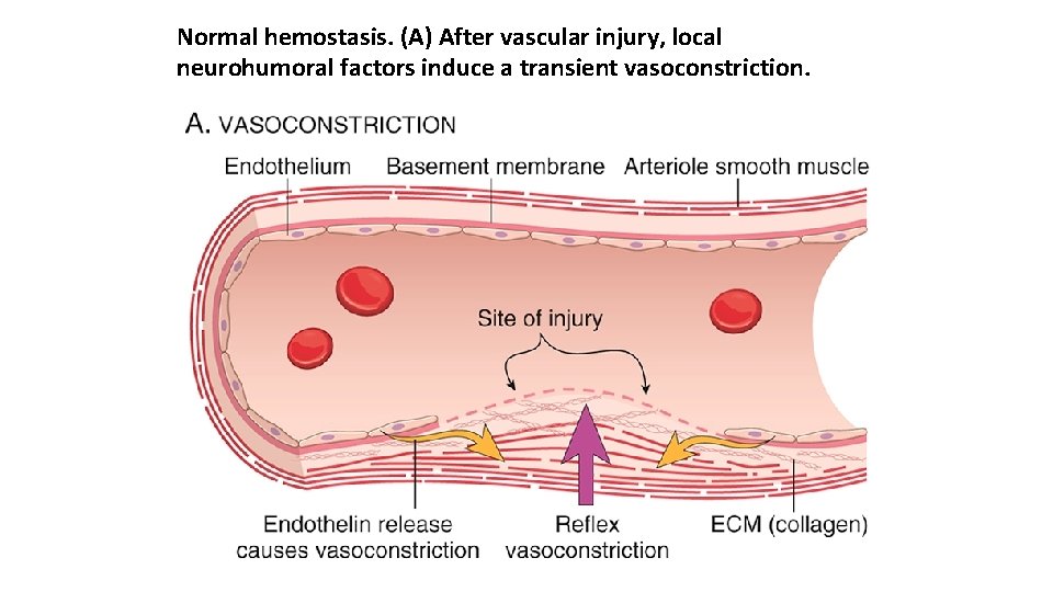 Normal hemostasis. (A) After vascular injury, local neurohumoral factors induce a transient vasoconstriction. 