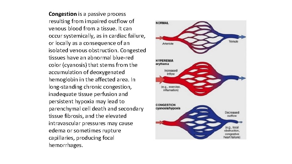Congestion is a passive process resulting from impaired outflow of venous blood from a