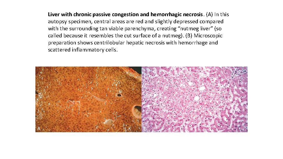 Liver with chronic passive congestion and hemorrhagic necrosis. (A) In this autopsy specimen, central