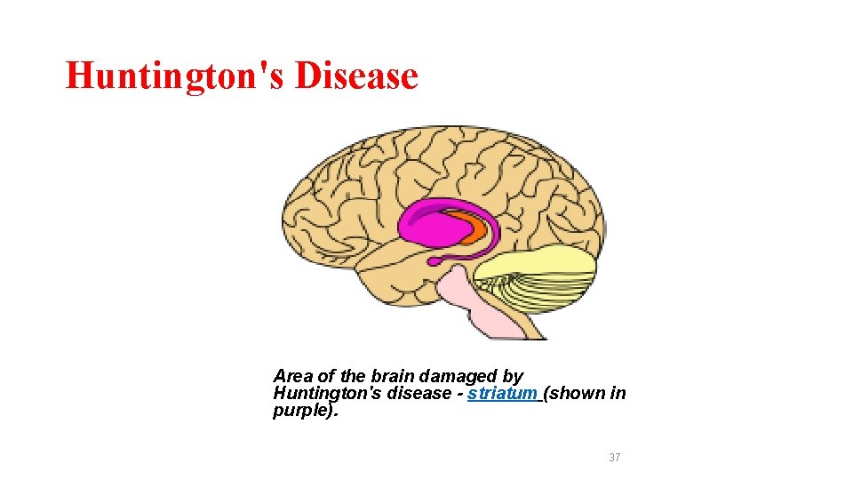 Huntington's Disease Area of the brain damaged by Huntington's disease - striatum (shown in