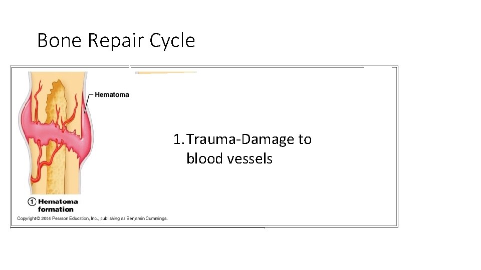 Bone Repair Cycle 1. Trauma-Damage to blood vessels 