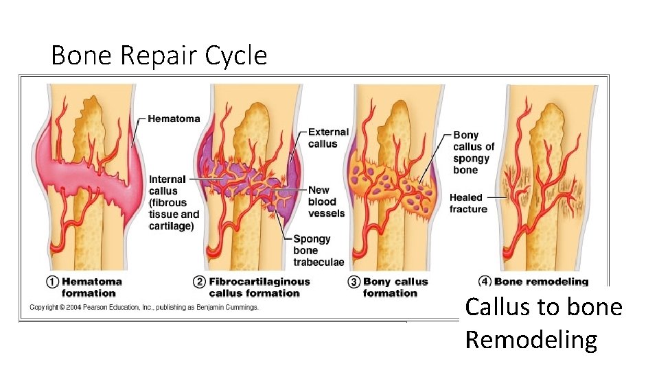 Bone Repair Cycle Callus to bone Remodeling 