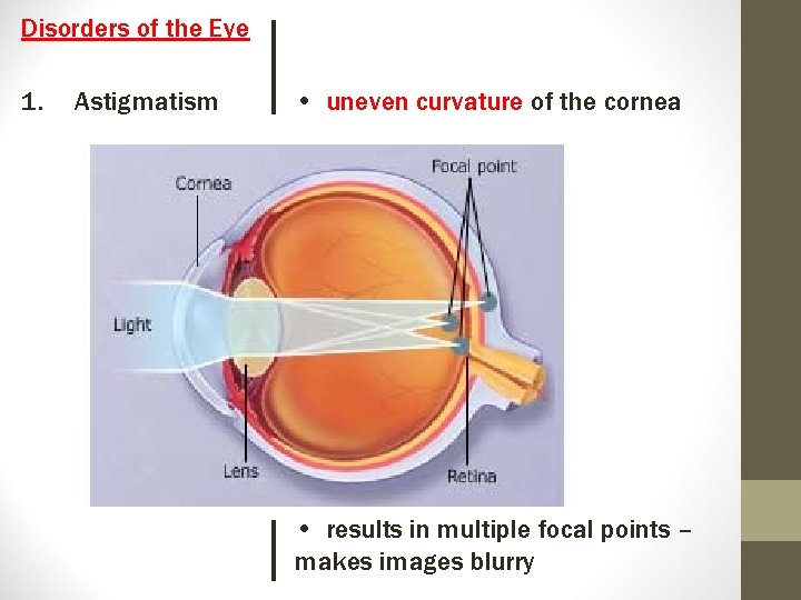 Disorders of the Eye 1. Astigmatism • uneven curvature of the cornea • results