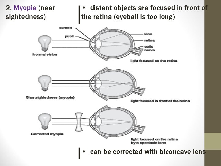 2. Myopia (near sightedness) • distant objects are focused in front of the retina