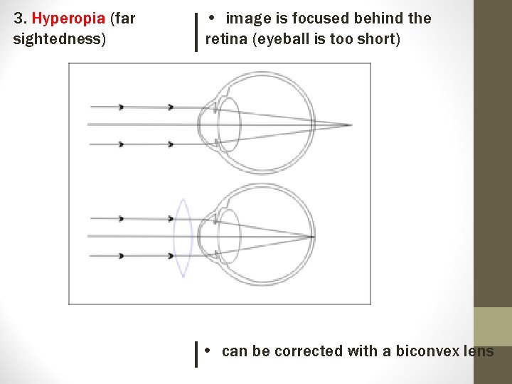 3. Hyperopia (far sightedness) • image is focused behind the retina (eyeball is too
