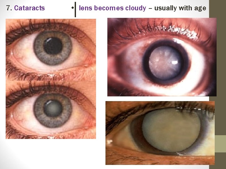 7. Cataracts • lens becomes cloudy – usually with age 