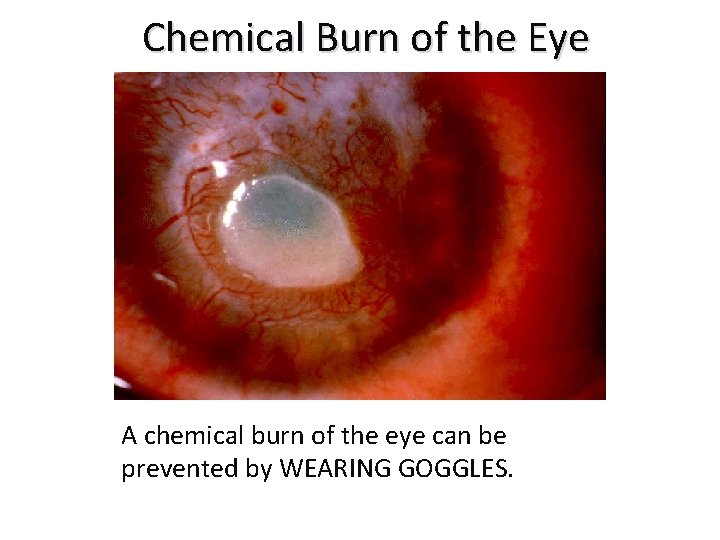 Chemical Burn of the Eye A chemical burn of the eye can be prevented