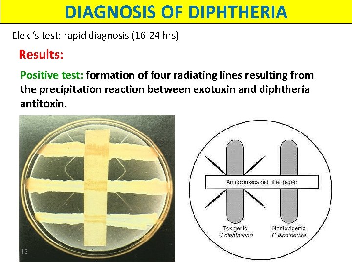 DIAGNOSIS OF DIPHTHERIA Elek ‘s test: rapid diagnosis (16 -24 hrs) Results: Positive test: