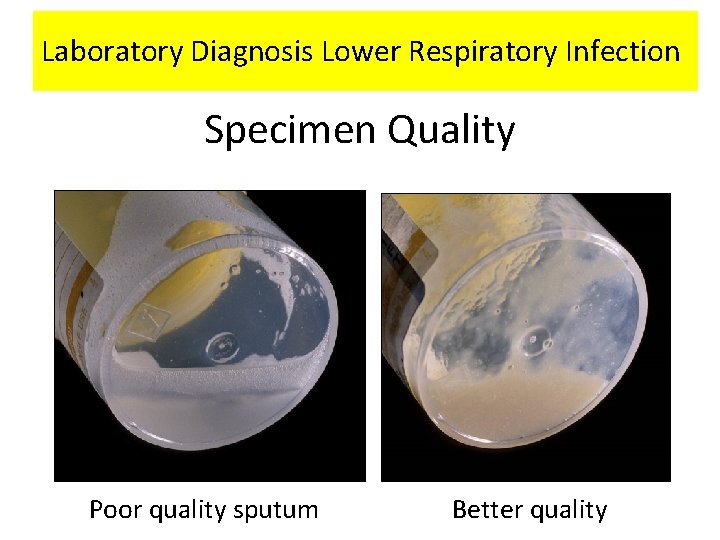 Laboratory Diagnosis Lower Respiratory Infection Specimen Quality Poor quality sputum Better quality 