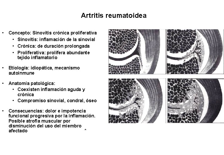 Artritis reumatoidea • Concepto: Sinovitis crónica proliferativa • Sinovitis: inflamación de la sinovial •