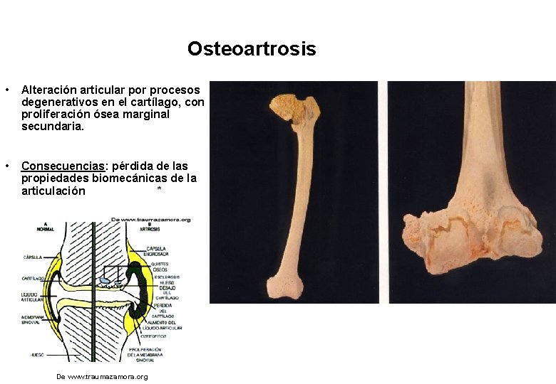 Osteoartrosis • Alteración articular por procesos degenerativos en el cartílago, con proliferación ósea marginal