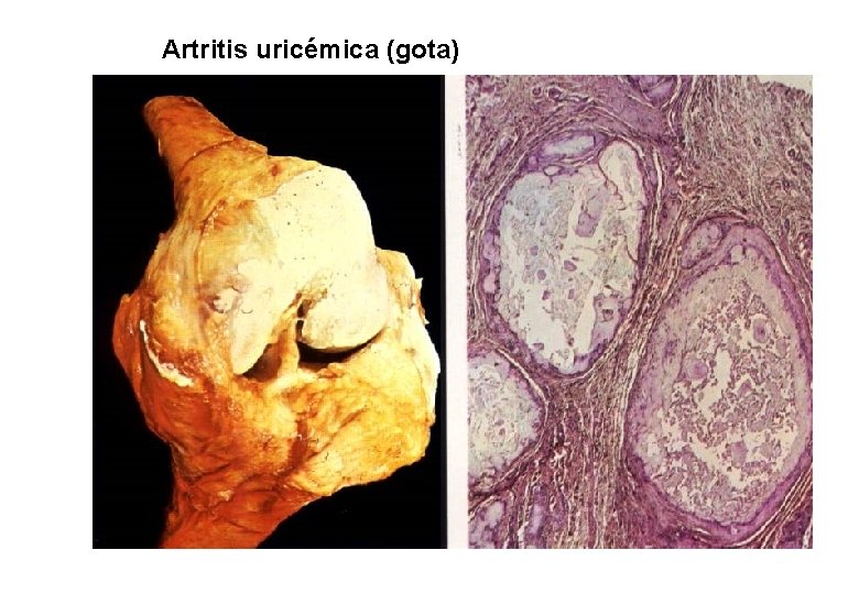 Artritis uricémica (gota) 