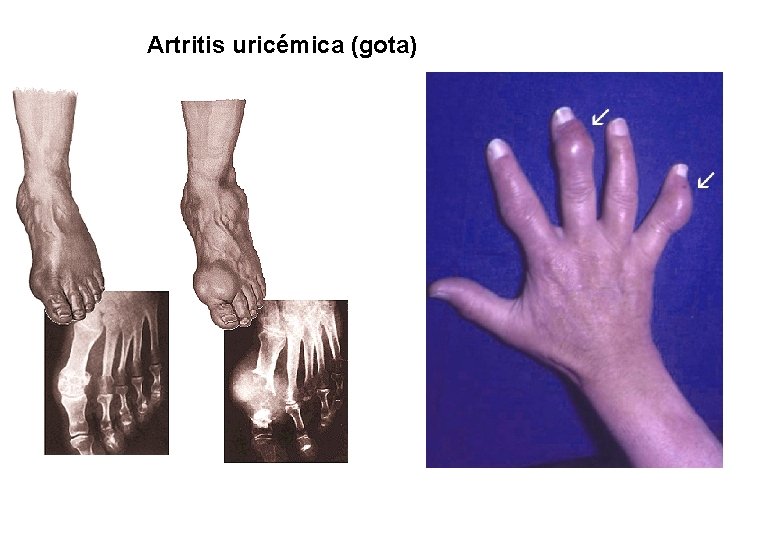 Artritis uricémica (gota) 