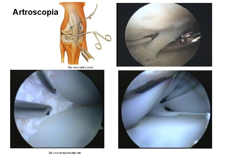 Artroscopía De www. sdro. com De www. traumaweb. net 