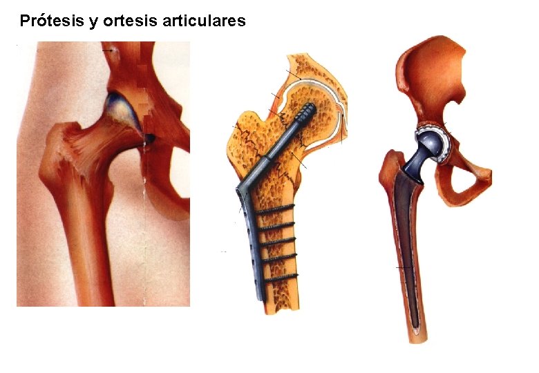 Prótesis y ortesis articulares 