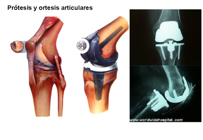 Prótesis y ortesis articulares 