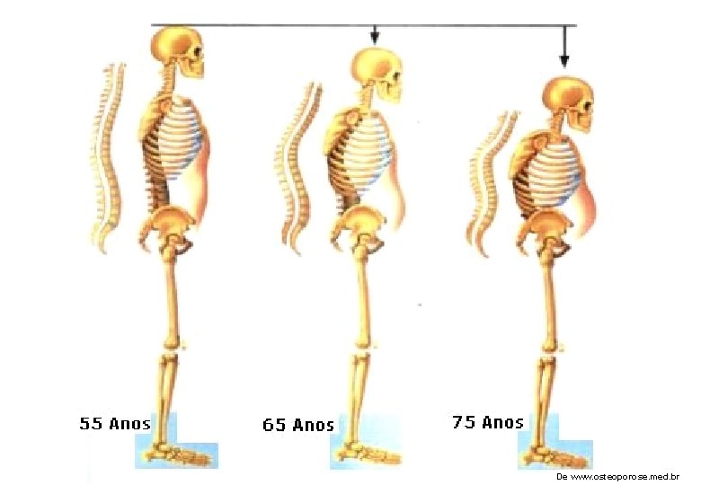 De www. osteoporose. med. br 