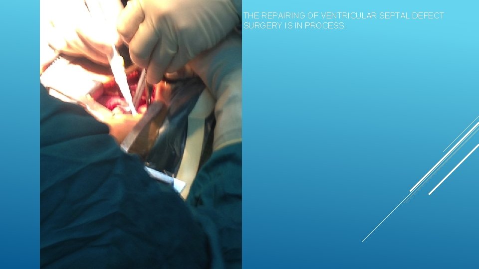 THE REPAIRING OF VENTRICULAR SEPTAL DEFECT SURGERY IS IN PROCESS. 