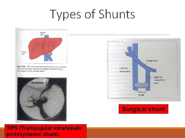 Types of Shunts Surgical shunt TIPS (Transjugular intrahepatic portosystemic shunt) 