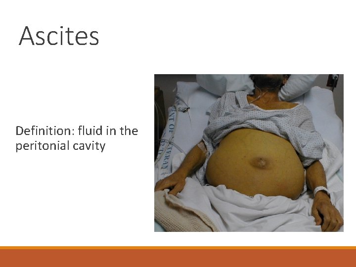 Ascites Definition: fluid in the peritonial cavity 