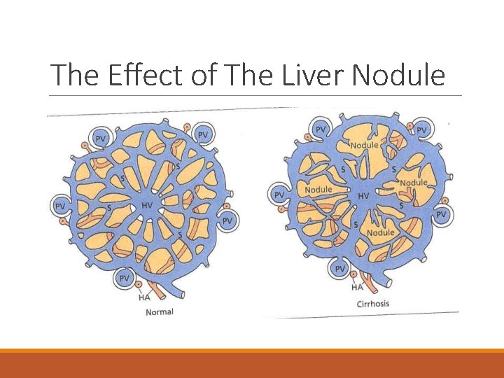 The Effect of The Liver Nodule 