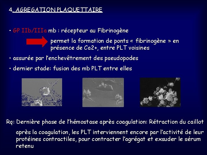 4. AGREGATION PLAQUETTAIRE • GP IIb/IIIa mb : récepteur au Fibrinogène permet la formation