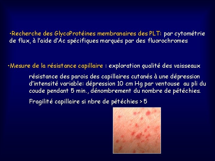  • Recherche des Glyco. Protéines membranaires des PLT: par cytométrie de flux, à