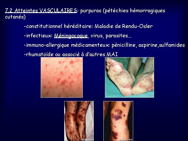 7. 2 Atteintes VASCULAIRES: purpuras (pétéchies hémorragiques cutanés) -constitutionnel héréditaire: Maladie de Rendu-Osler -infectieux: