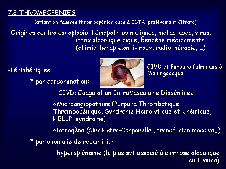 7. 3 THROMBOPENIES (attention fausses thrombopénies dues à EDTA, prélèvement Citrate) -Origines centrales: aplasie,