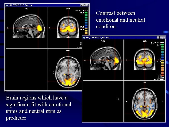 Contrast between emotional and neutral conditon. Brain regions which have a significant fit with