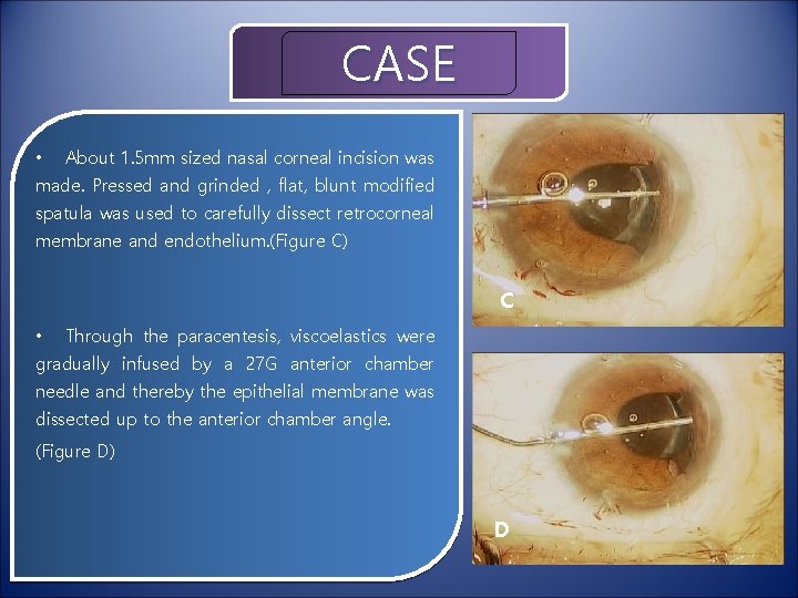 CASE • About 1. 5 mm sized nasal corneal incision was made. Pressed and