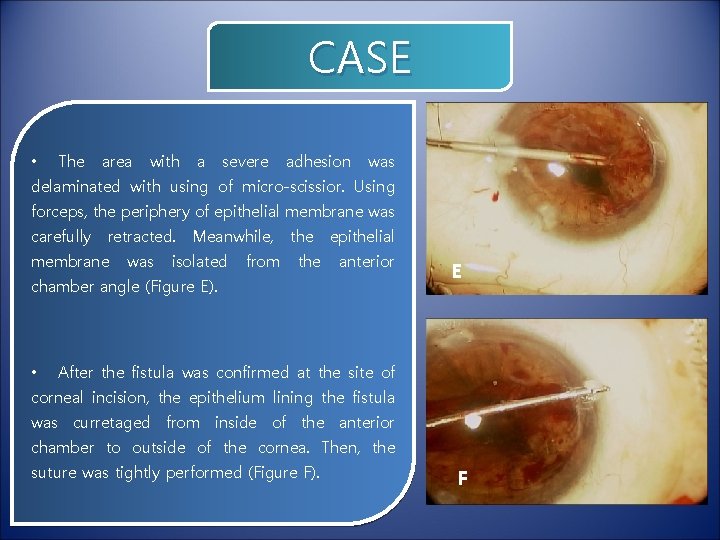 CASE • The area with a severe adhesion was delaminated with using of micro-scissior.