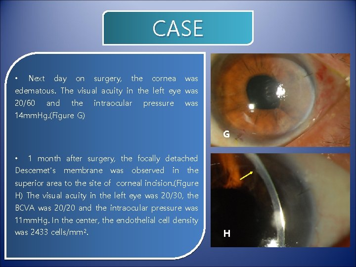 CASE • Next day on surgery, the cornea was edematous. The visual acuity in