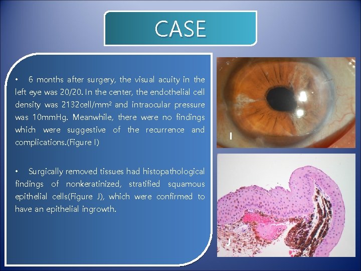 CASE • 6 months after surgery, the visual acuity in the left eye was