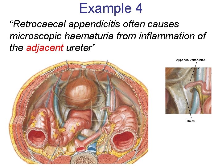 Example 4 “Retrocaecal appendicitis often causes microscopic haematuria from inflammation of the adjacent ureter”