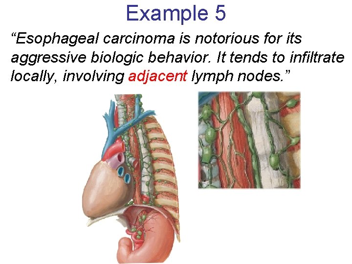 Example 5 “Esophageal carcinoma is notorious for its aggressive biologic behavior. It tends to