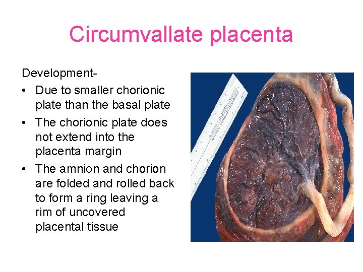 Circumvallate placenta Development • Due to smaller chorionic plate than the basal plate •