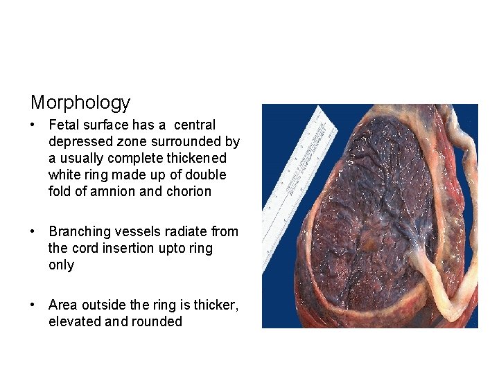 Morphology • Fetal surface has a central depressed zone surrounded by a usually complete