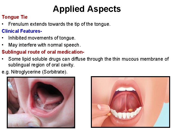 Applied Aspects Tongue Tie • Frenulum extends towards the tip of the tongue. Clinical