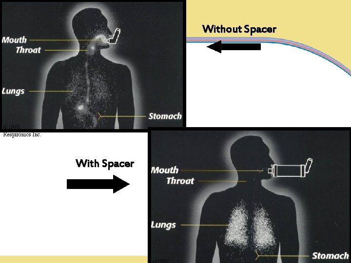 Without Spacer © 1998, Respironics Inc. With Spacer 